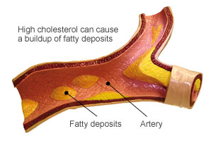 High Cholesterol in the blood